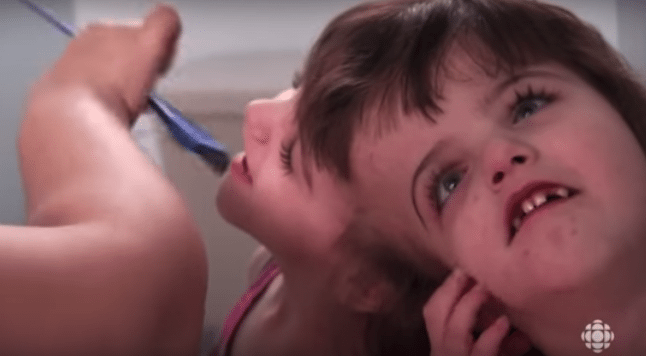 Meet the Incredible Conjoined Twins Tatiana and Krista that Can See Out of Each Others Eyes and Know Each Others Thoughts