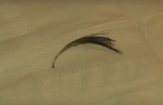 Baby Taken To ER After Neck Swells Up, Then Dr. Finds Bizarre Item Poking Through Her Skin!