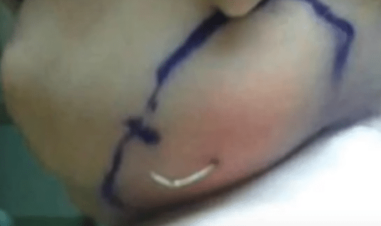 Baby Taken To ER After Neck Swells Up, Then Dr. Finds Bizarre Item Poking Through Her Skin!