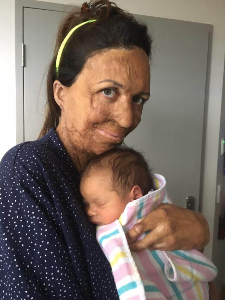 Man Gives Perfect Response When Asked If He’ll Stay With Wife After Fire Destroys Her Skin