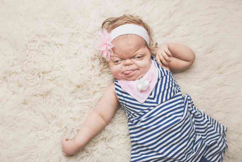 She Was Given Less Than A Year To Live When She Was Born, Now 4-Years Old She Defies the Odds