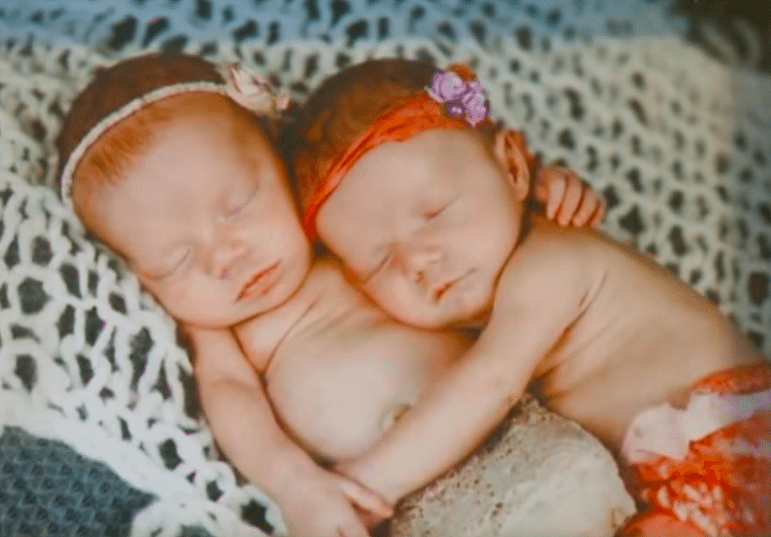 Mother Of ‘Miracle Sisters’ Born Holding Hands Explains How The Twins Helped Each Other Survive Their 1st Year Of Life