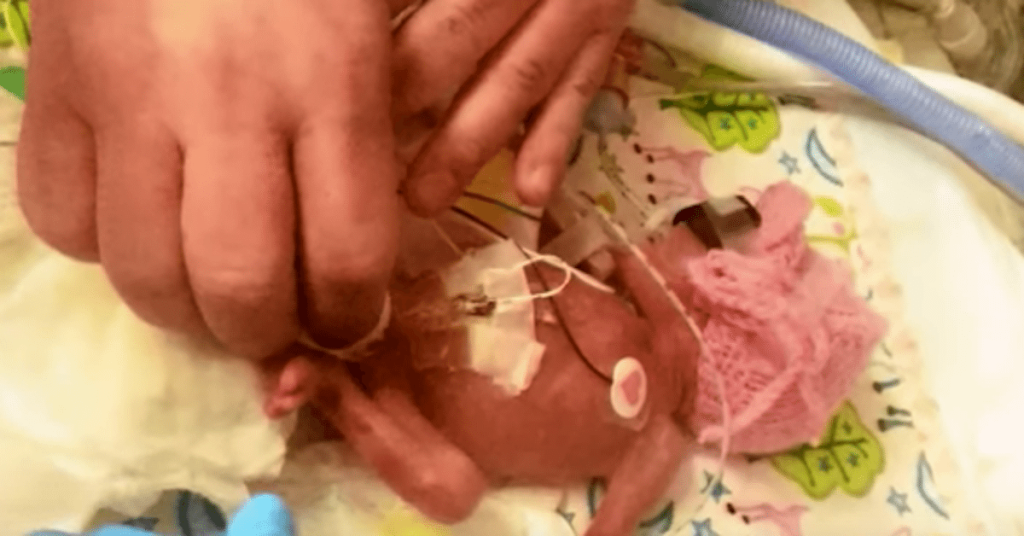 Baby Born At 24-Weeks Had Feet The Size Of Pennies And Now This Little Miracle Is Proving Everyone Wrong