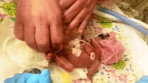 Baby Born At 24-Weeks Had Feet The Size Of Pennies And Now This Little Miracle Is Proving Everyone Wrong