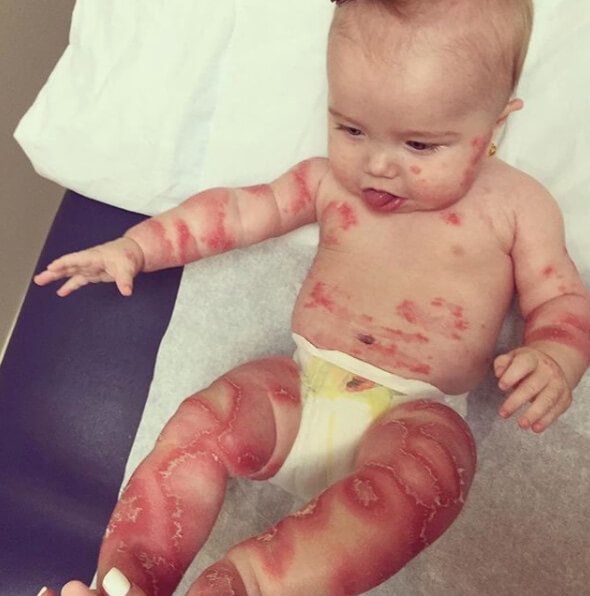 Strangers Are Afraid To Catch Baby’s Disease… So Fed-Up Mom Decides To Do This In Public