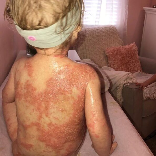 Strangers Are Afraid To Catch Baby’s Disease… So Fed-Up Mom Decides To Do This In Public