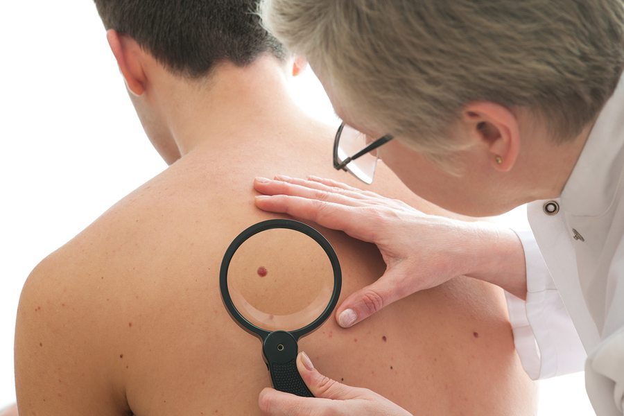 Not Worried About Skin Cancer? 4.3 million cases are reported in the US each year