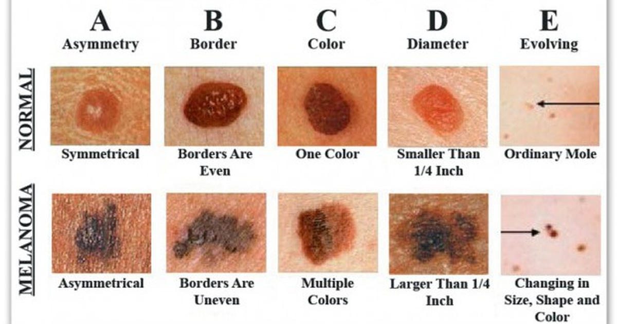 Not Worried About Skin Cancer? 4.3 million cases are reported in the US each year