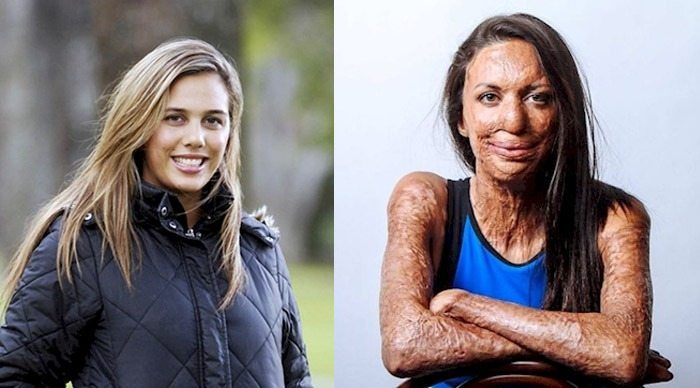 Man Gives Perfect Response When Asked If He’ll Stay With Wife After Fire Destroys Her Skin