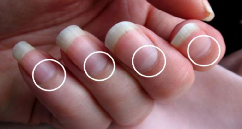 Does The Absences Of The Half Moon Shape On Your Nails Mean Your Body Is Telling You Something?