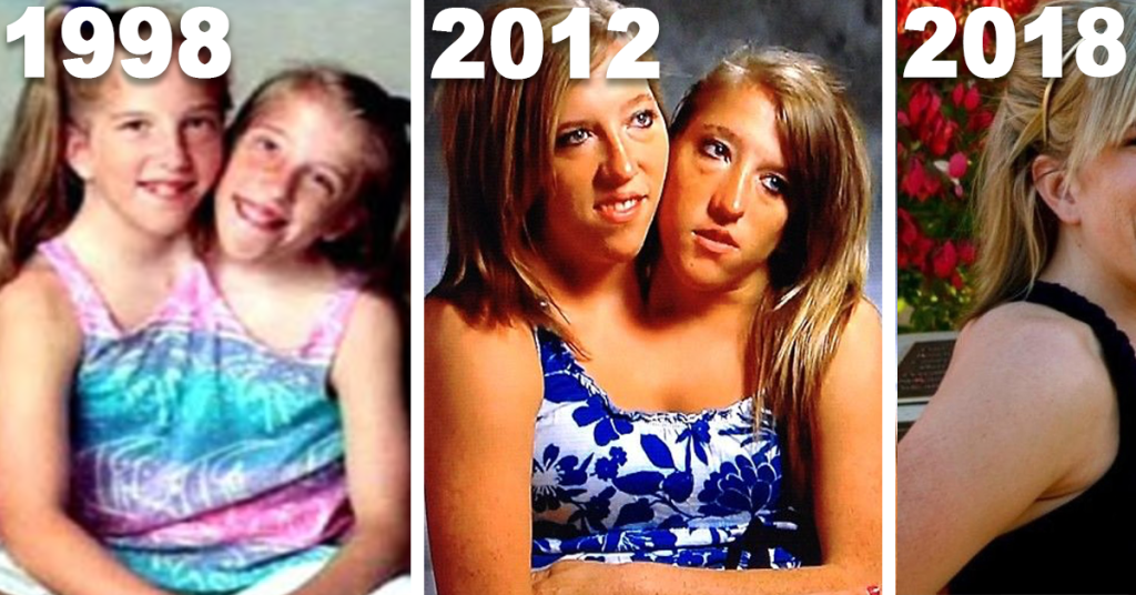 What Conjoined Twins Abby And Brittany Hensel Look Like Today