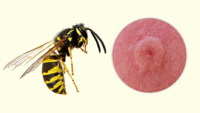 10 Common Insect Bites and Stings Everyone Should Learn to Recognize