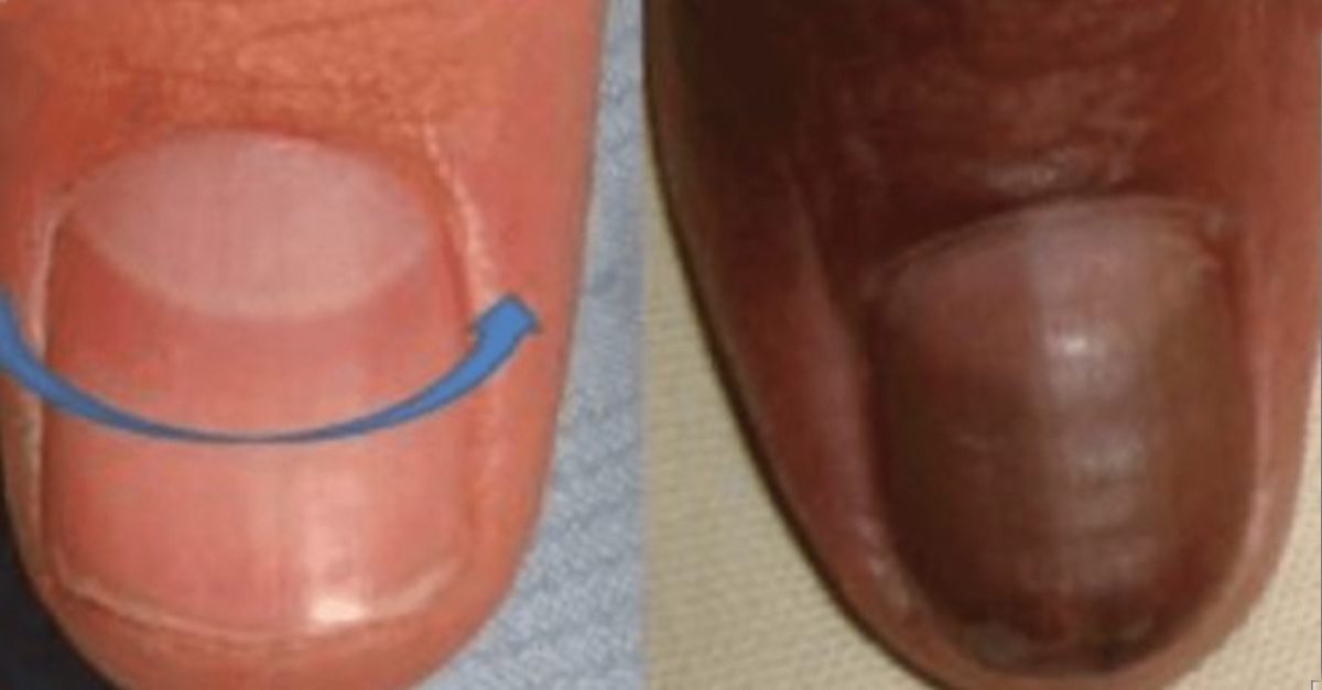 Does The Absences Of The Half Moon Shape On Your Nails Mean Your Body Is Telling You Something?