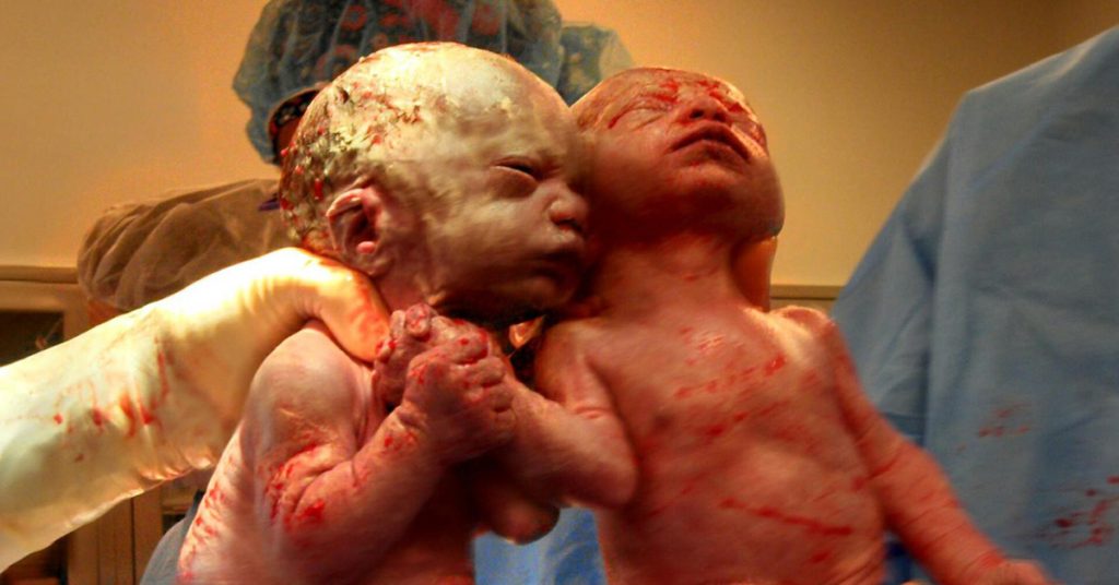 These Twins Are One in a Million! You Won’t Believe Their Miraculous Birth! So Touching!