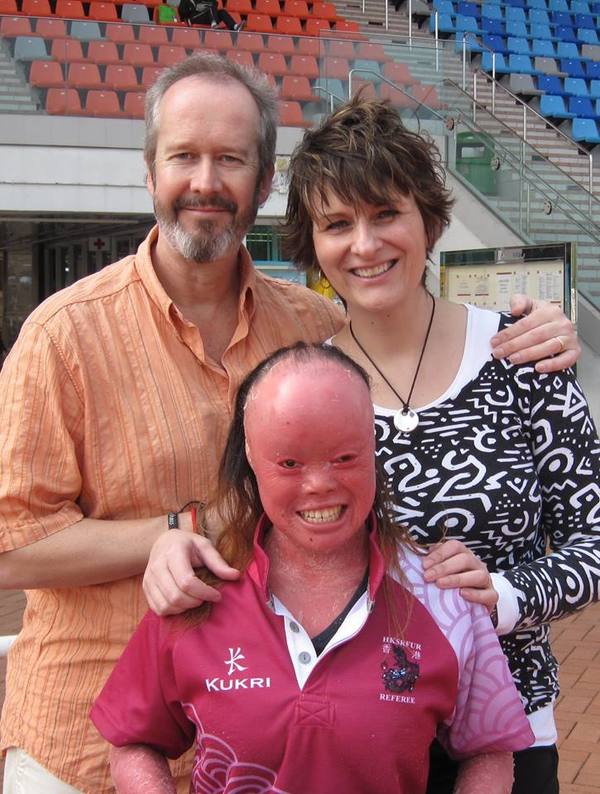 ‘Bright Red’ Baby Was Not Expected To Live Long But Here She Is 20 Years Later