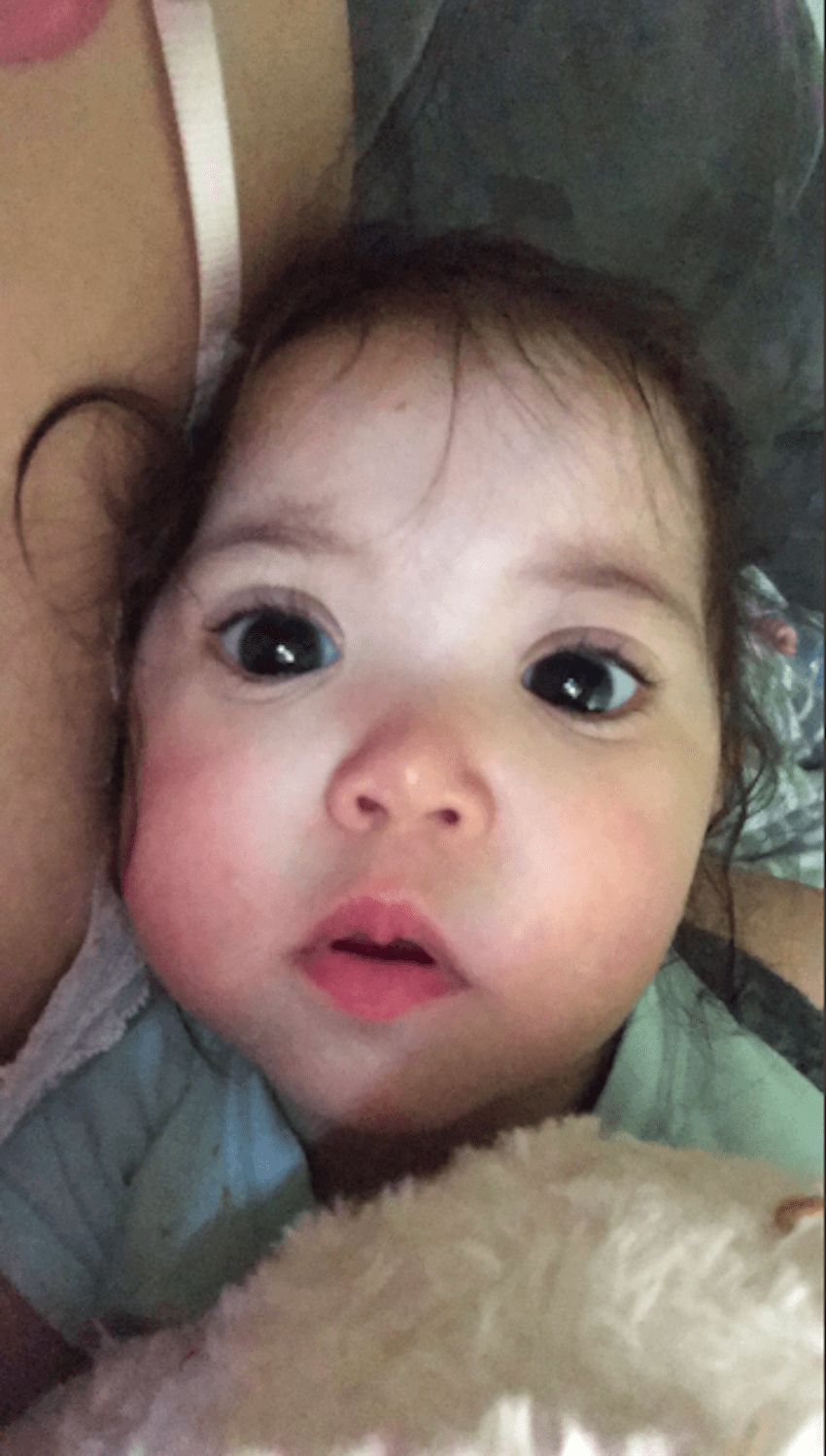 Toddler’s Big Eyes Resemble A Disney Princess, But They’re Due To A Rare Condition