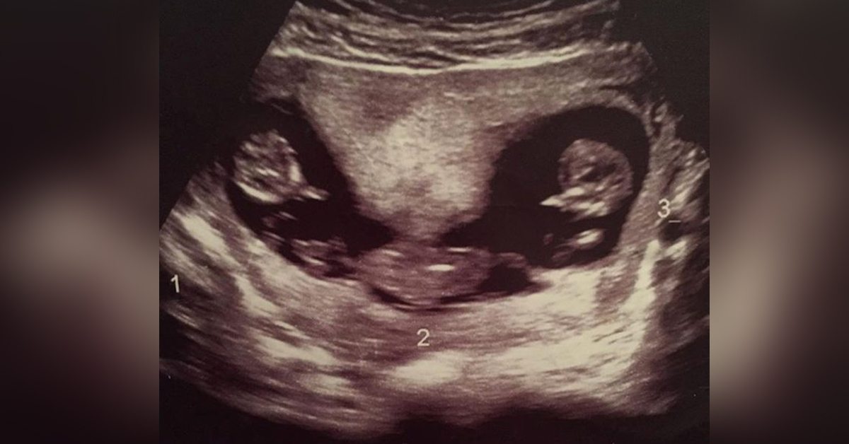Mom gives birth to identical triplets – The chances of it happening can be as high as 1 in 200 million