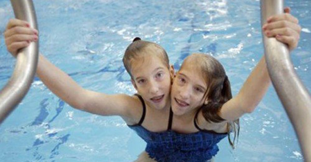 What Conjoined Twins Abby And Brittany Hensel Look Like Today