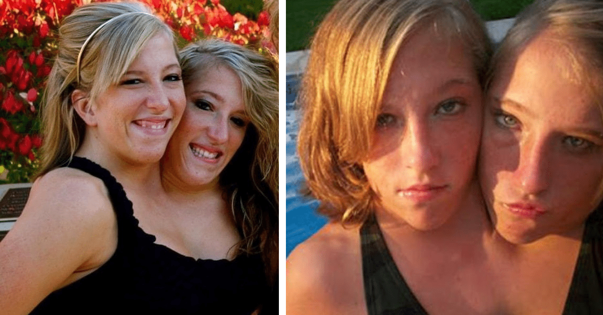 What Conjoined Twins Abby And Brittany Hensel Look Like Today