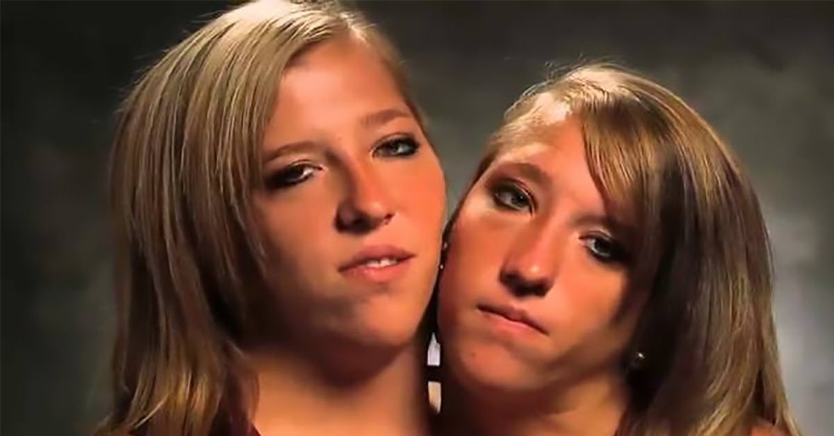 What Conjoined Twins Abby And Brittany Hensel Look Like Today