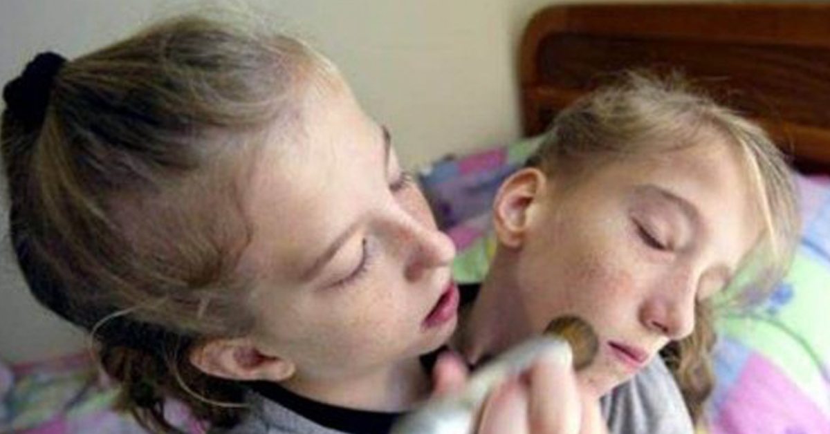 What Conjoined Twins Abby And Brittany Hensel Look Like Today
