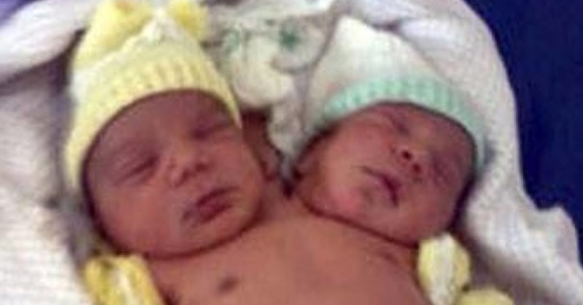 What Conjoined Twins Abby And Brittany Hensel Look Like Today