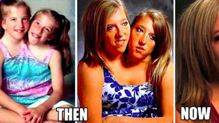 What Conjoined Twins Abby And Brittany Hensel Look Like Today