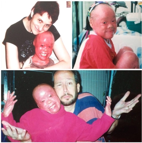 Baby Suffers From Rare Condition But Defies All Odds And Is Now 23-years-old
